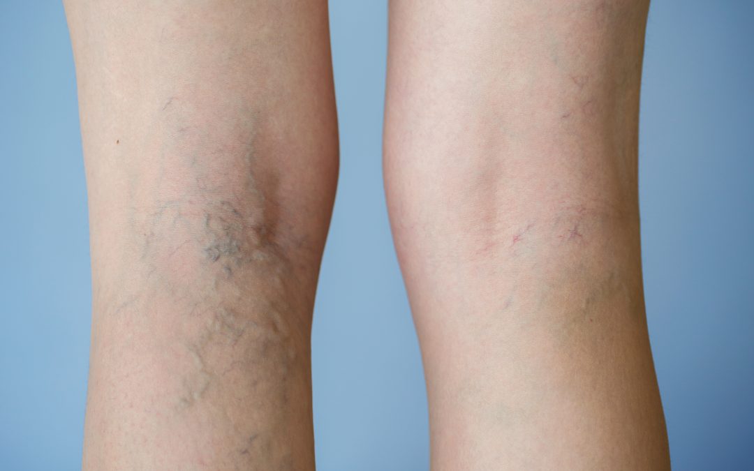 Learn about treatment options for Deep Vein Thrombosis in Baltimore, MD, to regain mobility
