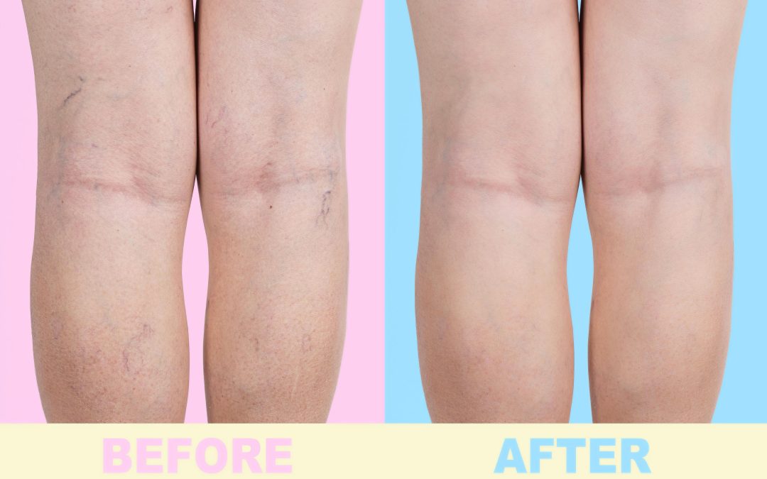 Your Comprehensive Guide to Varicose Veins Treatment in Norfolk, VA for Lasting Relief