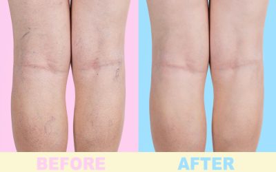 Your Comprehensive Guide to Varicose Veins Treatment in Norfolk, VA for Lasting Relief