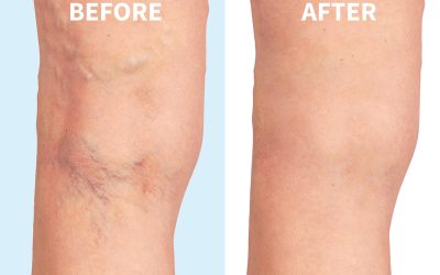 Relief from Pain and Swelling with Spider Veins Treatment in Baltimore, MD Solutions