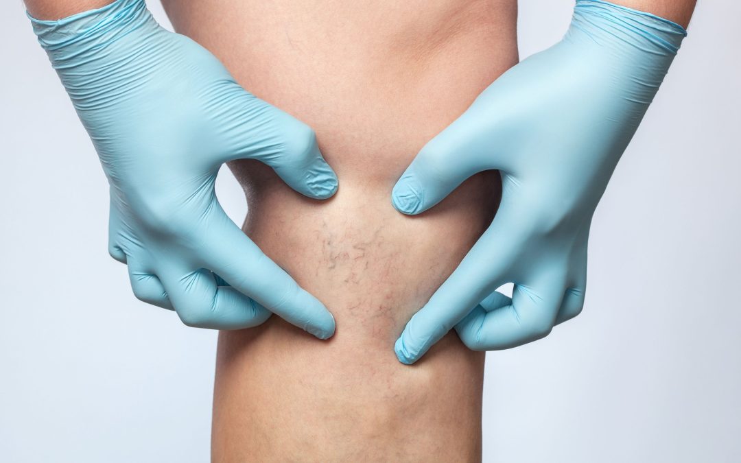 Benefits Patients Experience With Varicose Veins Treatment in Petersburg, VA